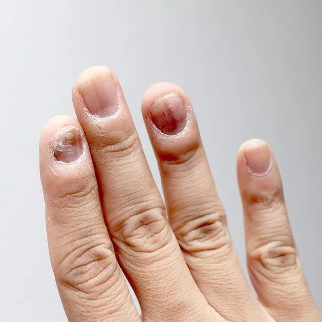 Mycose des ongles : prévenir et traiter l'onychomycose - Conseils santé